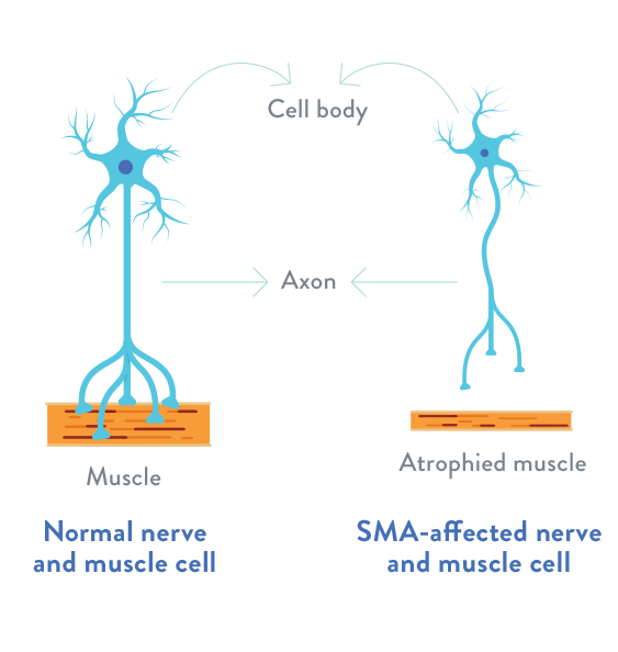 Spinal Muscular Atrophy SMN Protein