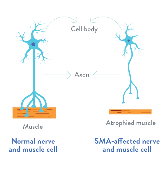 Spinal Muscular Atrophy SMN Protein